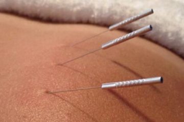 Close-up of three acupuncture needles inserted into a person's skin with a towel in the background. The needles are thin and metallic, positioned at an angle, demonstrating the practice of acupuncture.