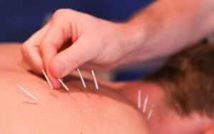 A close-up view of a person's back undergoing acupuncture treatment. Multiple thin, metallic needles are inserted into the skin along the spine, with a practitioner's hand placing one of the needles. The background is blurred.